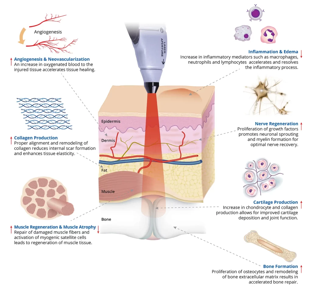 Bioflex Laser - Vancouver - What is Photobiomodulation Therapy (PBMT)?